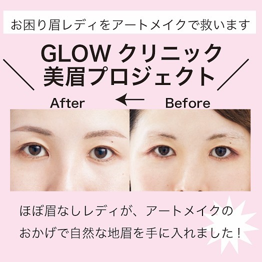 Glowクリニックの美眉プロジェクト 第２回は ほぼ眉なしレディが登場 若いころに眉毛を抜きすぎて 今はすっかり生えてこなくなってしまった とお悩みのモニタ Magmoe
