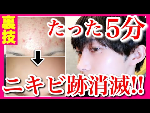 【裏技】みんな知らないニキビ跡の唯一の治し方