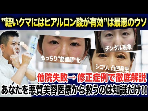 ”大物芸能人も被害者に”クマ治療にヒアルロン酸はやってはいけない最悪治療。その理由を徹底解説します。 ”大物芸能人も被害者に”クマ治療にヒアルロン酸はやってはいけない最悪治療。その理由を徹底解説します。