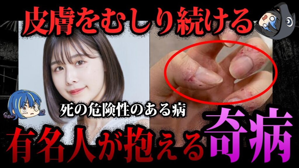 【ゆっくり解説】命に関わる病…有名人が抱える奇病5選 【ゆっくり解説】命に関わる病…有名人が抱える奇病5選