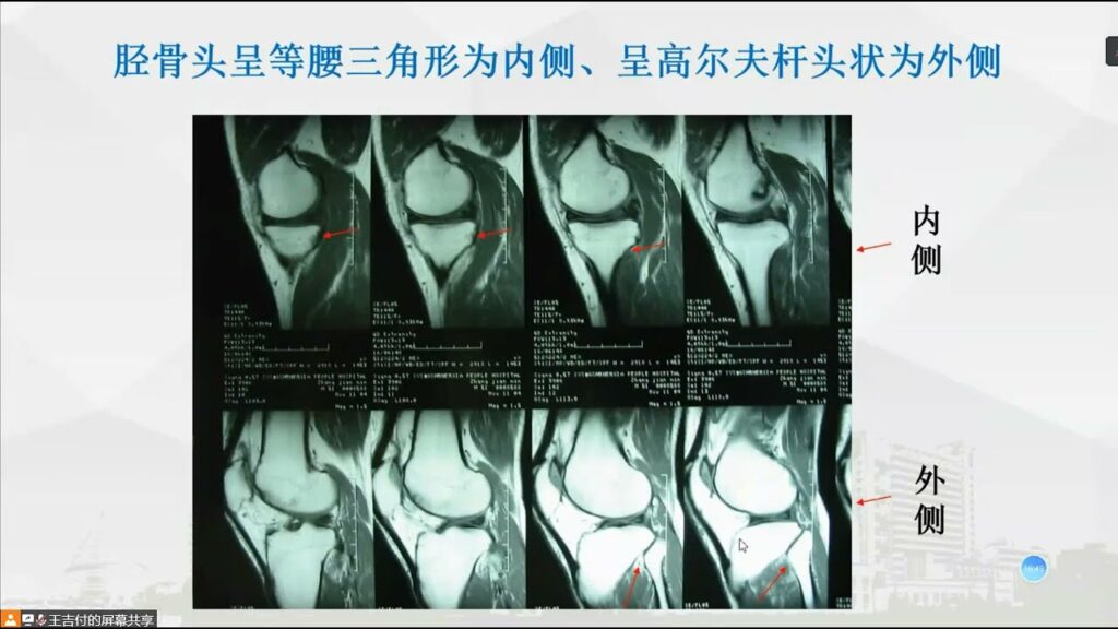 肌骨影像：04 膝关节影像学解剖及常见损伤读片要点 何菲