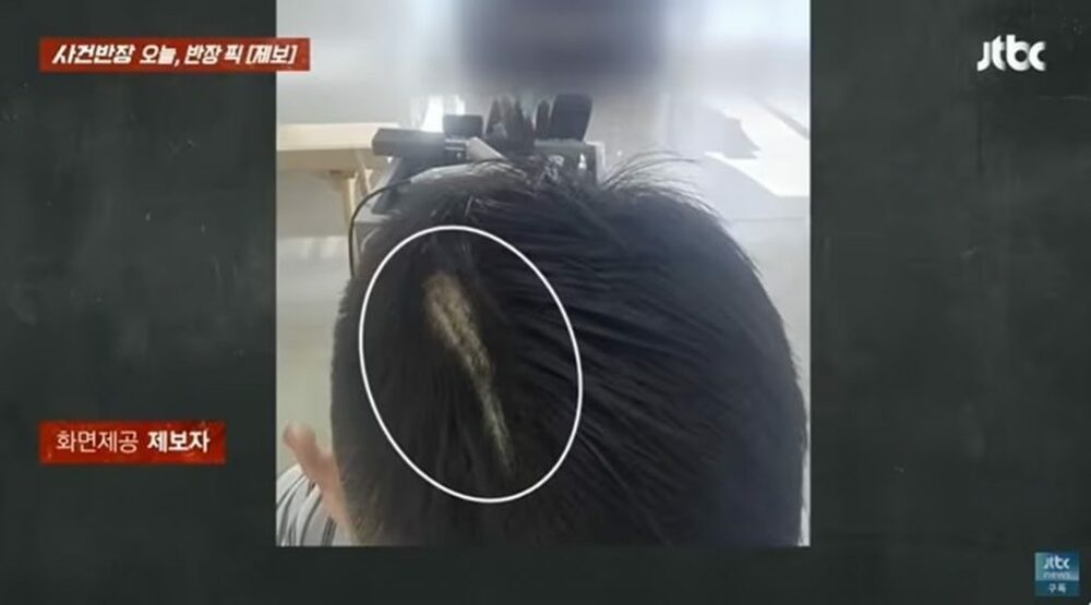 髪を切ったら“5センチの溝”が…韓国・美容室、女性の頭部に「バリカン跡」の悲劇　写真枚　国際ニュース：AFPBB News