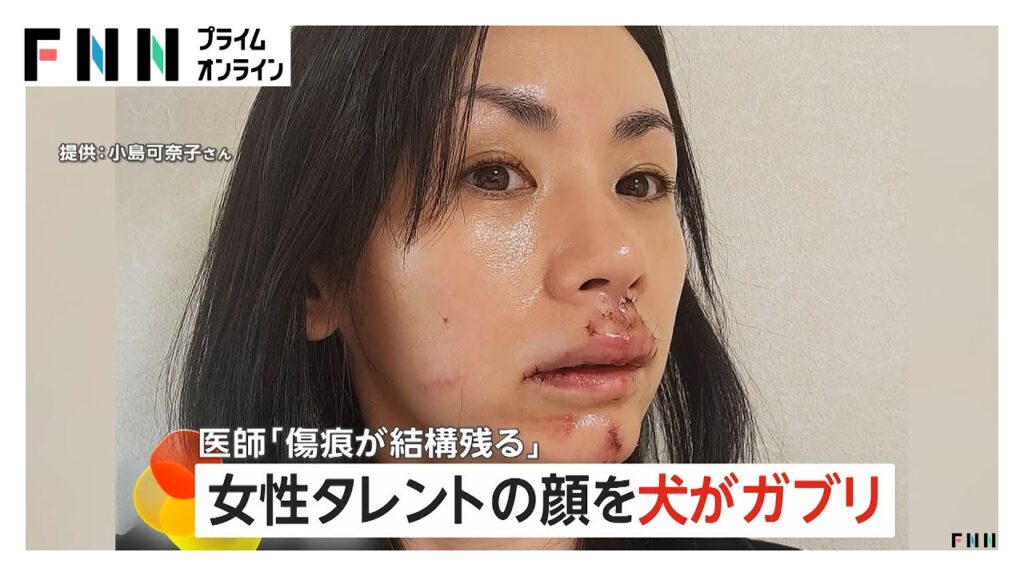 タレント・小島可奈子さんの顔を犬が“ガブリ”「傷跡が残ります」医師が断言…30針も縫う大けが タレント・小島可奈子さんの顔を犬が“ガブリ”「傷跡が残ります」医師が断言…30針も縫う大けが