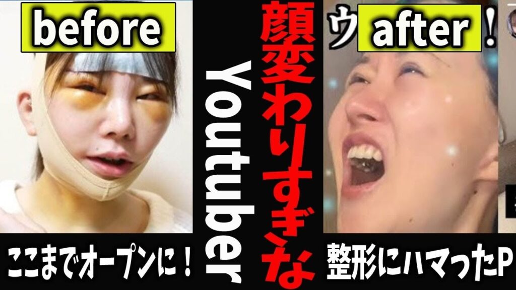 【ガルちゃん芸能】顔かわりすぎな整形Youtuber【有益2ch】