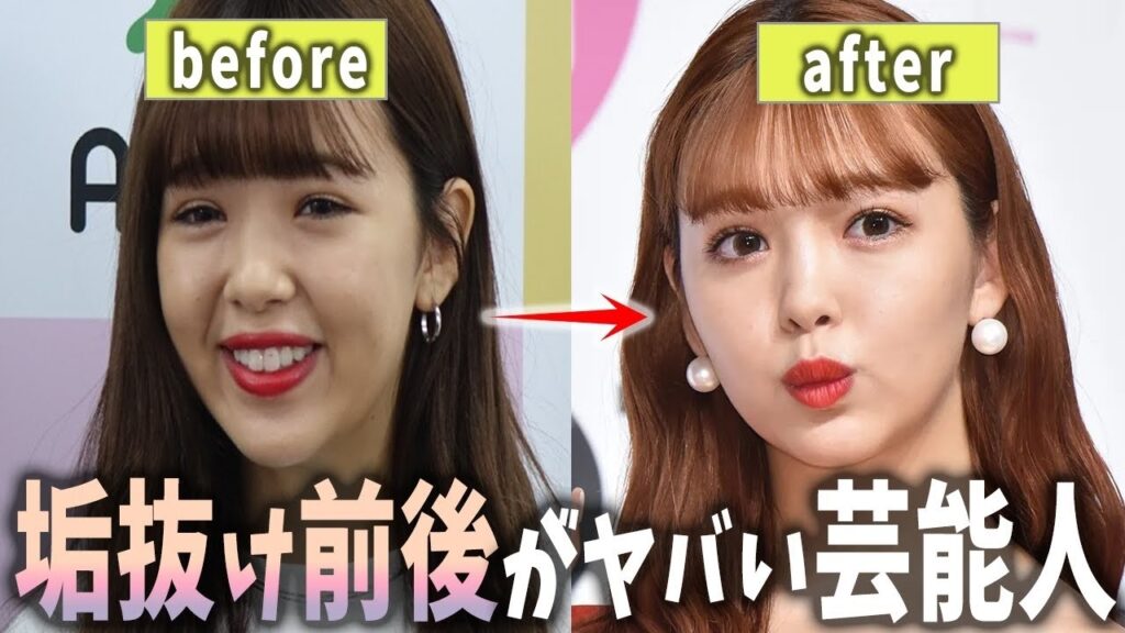 【芸能】垢抜け前後のギャップがヤバい芸能人【ガルちゃんまとめ】 【芸能】垢抜け前後のギャップがヤバい芸能人【ガルちゃんまとめ】
