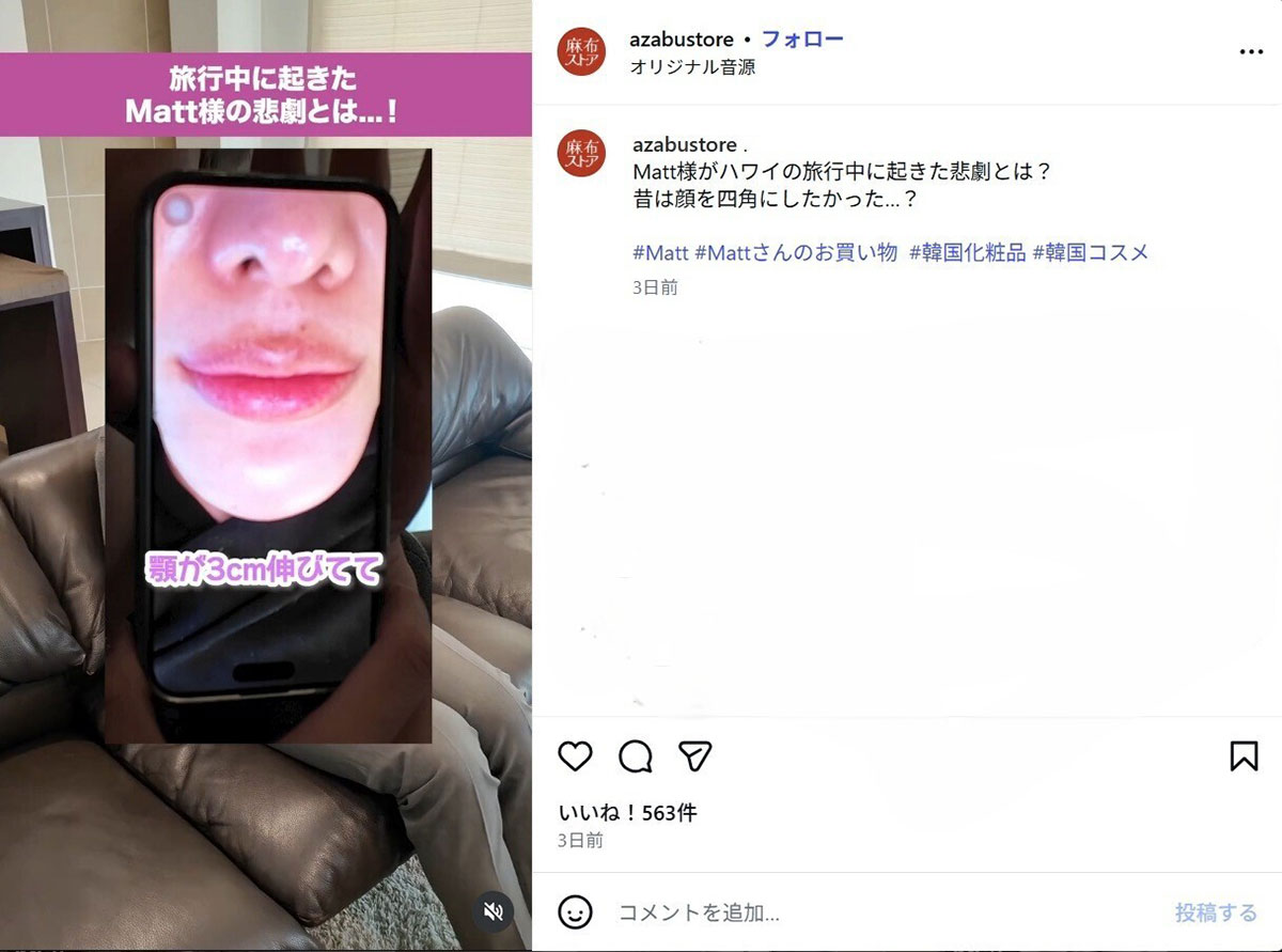顎が伸びた際の写真を公開したタレントのMatt(@azabustoreのInstagramより)